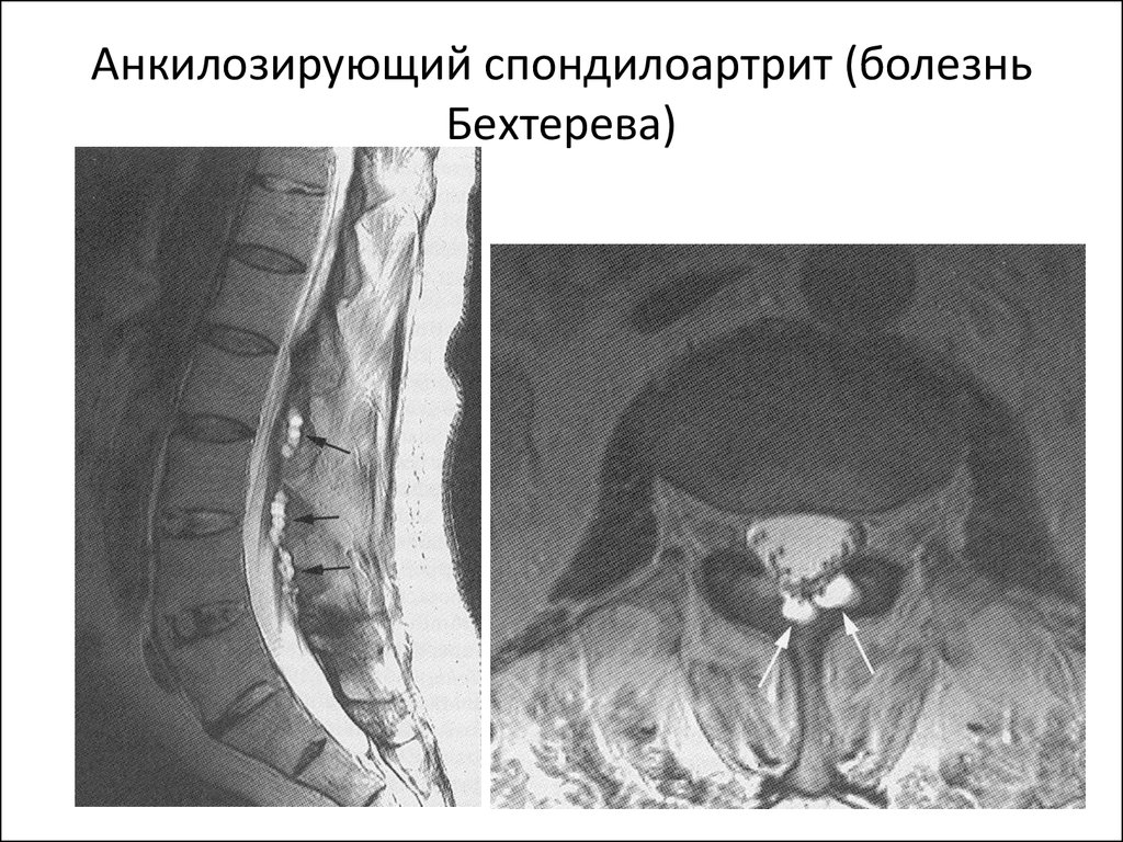 Спондилоартрит. Анкилозирующий спондилит синдромы. Болезнь Бехтерева-анкилозирующий. Спондилоартрит Бехтерева. Анкилозирующего спондилоартрита Бехтерева.