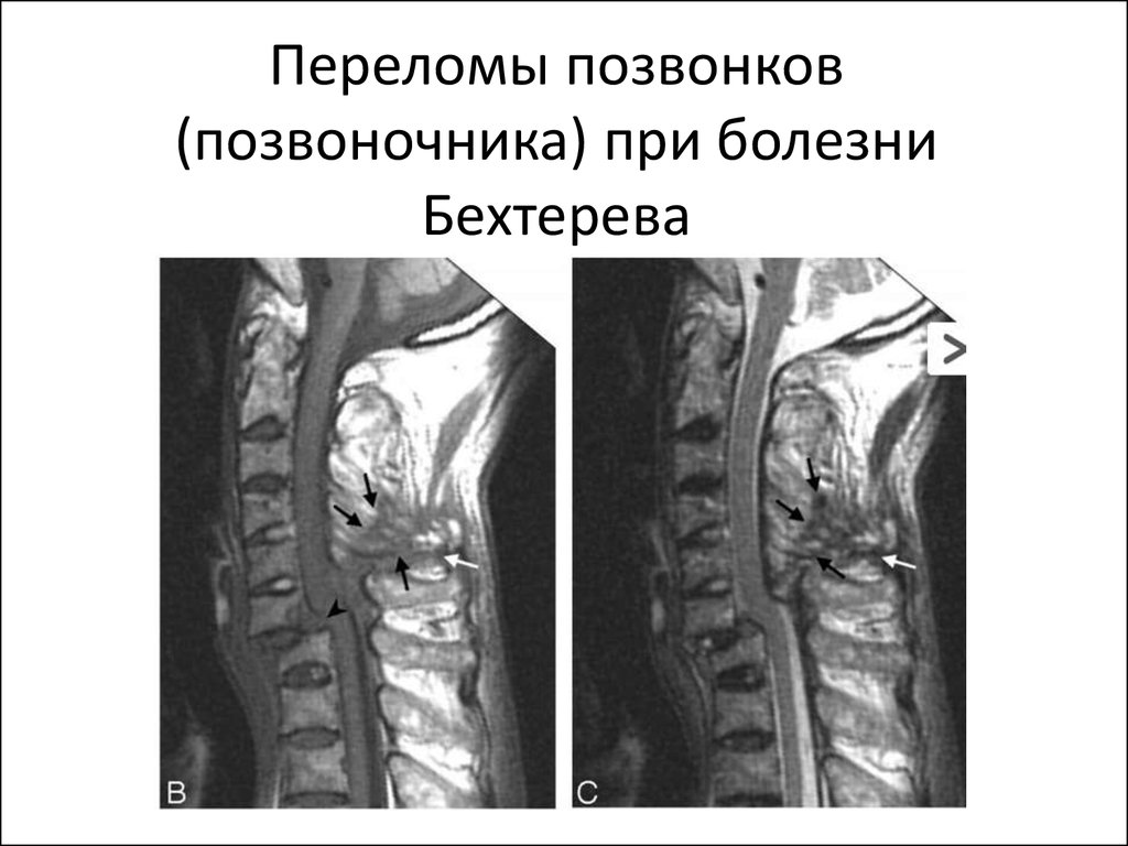 Какую картину дает мрт при болезни бехтерева