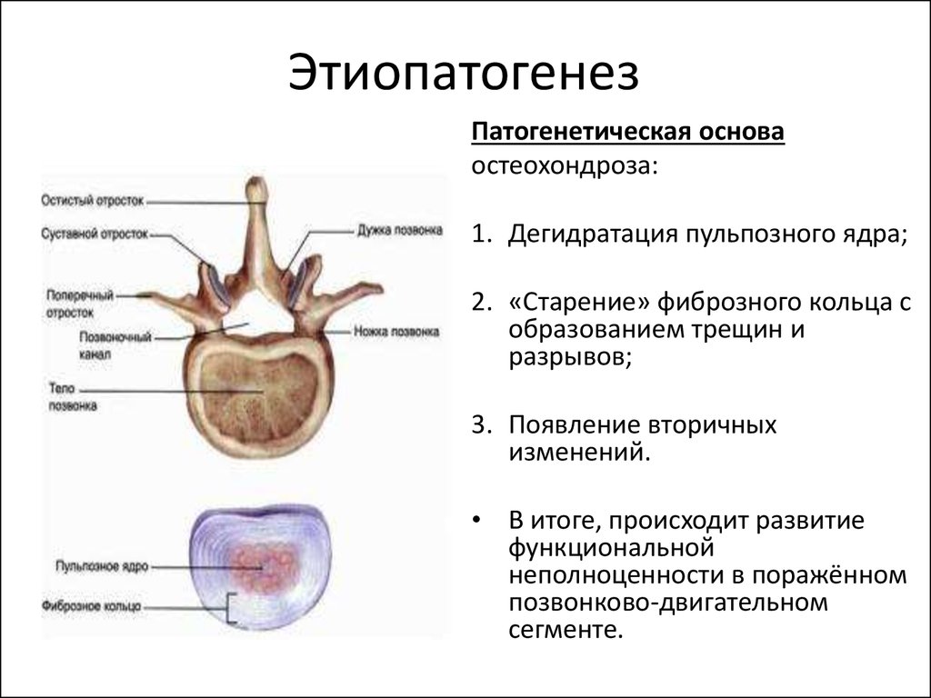 Дегидратация позвоночника. Патогенез остеохондроза схема. Остеохондроз позвоночника патогенез кратко. Дегидратация пульпозного ядра. Остеохондроз позвоночника этиология патогенез.