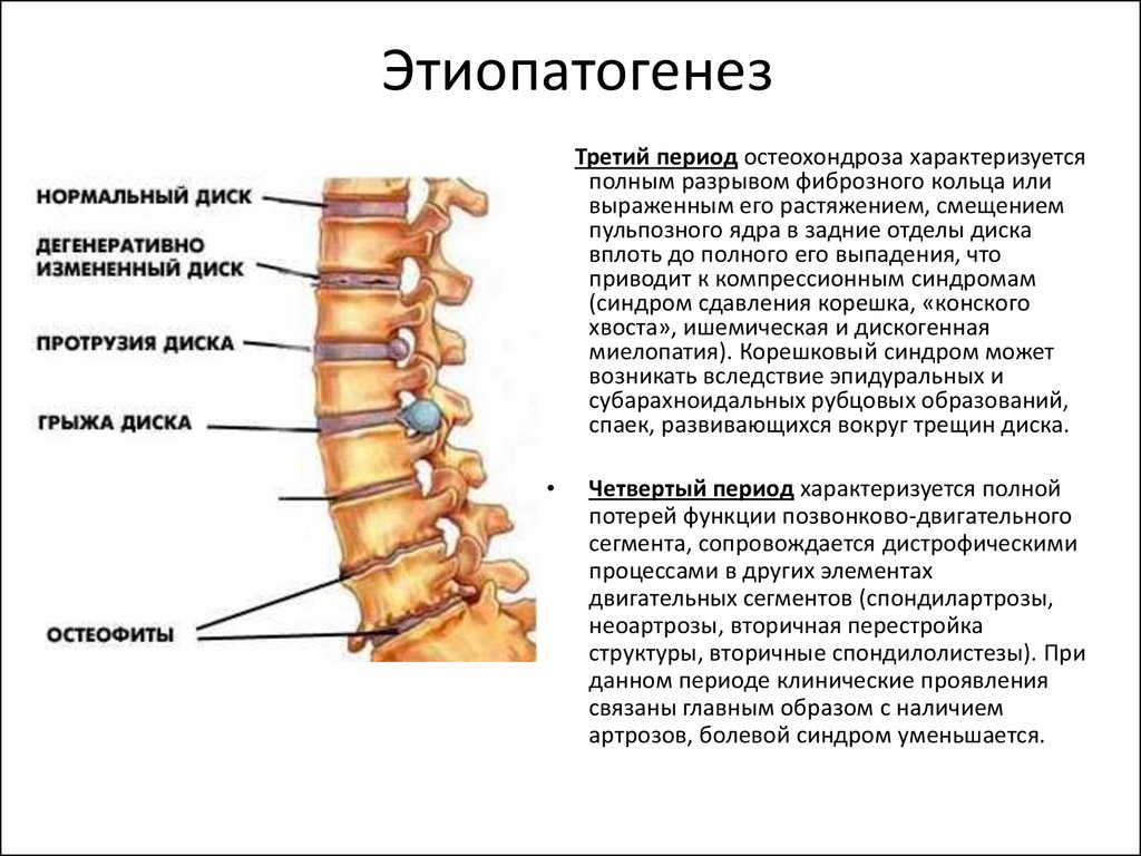 Краевые остеофиты тел позвонков