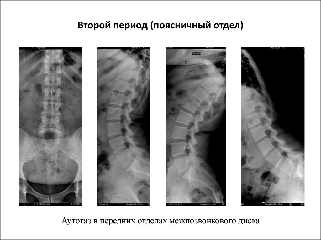 Остеохондроз 1 период. Рентген поясничного отдела с остеохондрозом 1 степени. Остеохондроз поясничного отдела позвоночника рентген. Остеохондроз поясничного отдела 3 степени рентген. Остеохондроз 2 степени шейного отдела снимок.