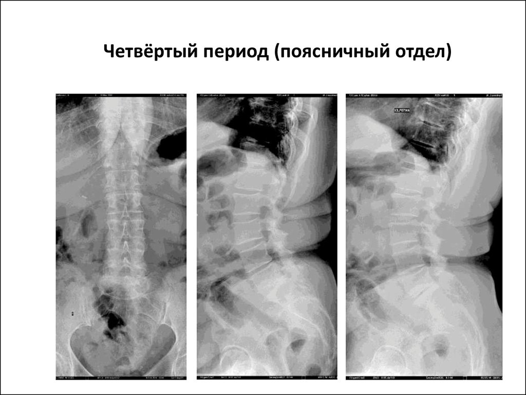 Iv период. Рентген поясничного отдела с остеохондрозом 1 степени. Остеохондроз поясничного отдела 3 степени рентген. Периоды остеохондроза рентген. Остеохондроз поясничного отдела рентген периоды.