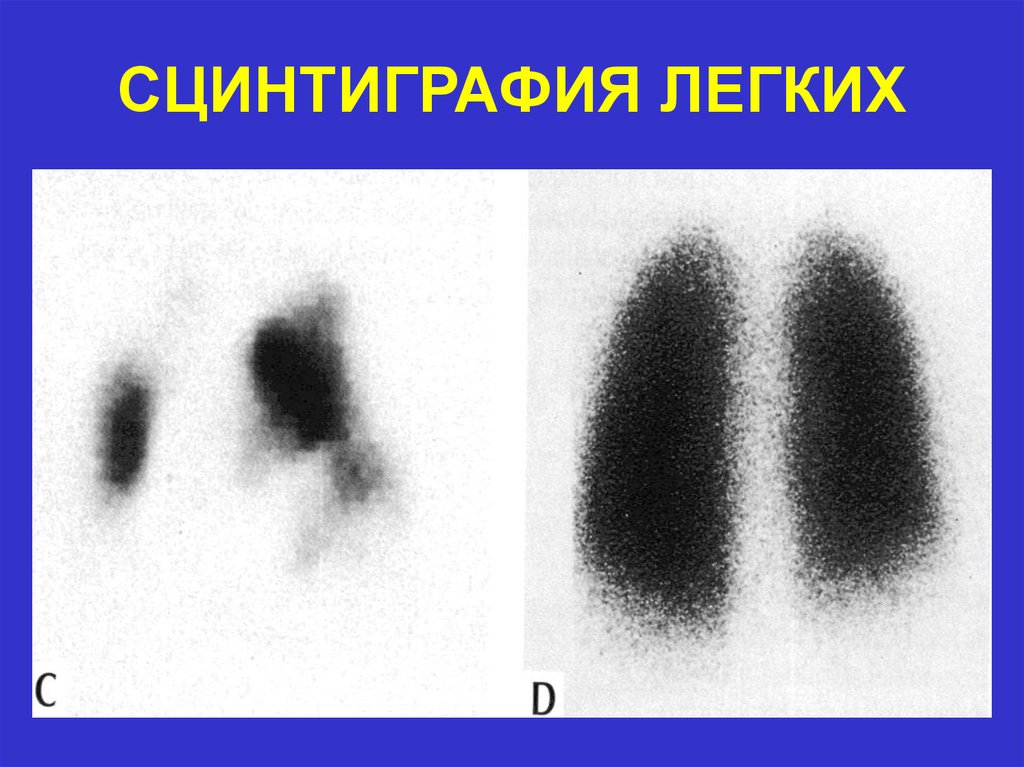 Сцинтиграмма является изображением