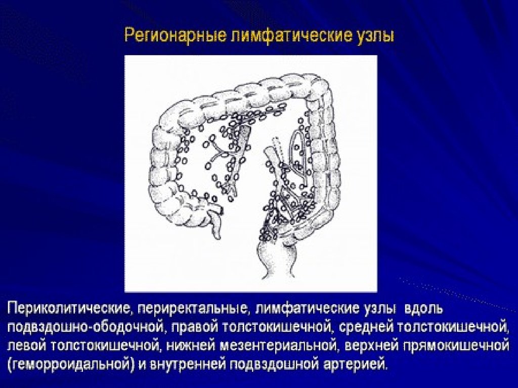 Рак ободочной кишки. Регионарные лимфатические узлы толстой кишки. Регионарные лимфатические узлы ободочной кишки. Лимфатические узлы Толстого кишечника. Регионарные лимфоузлы Толстого кишечника.