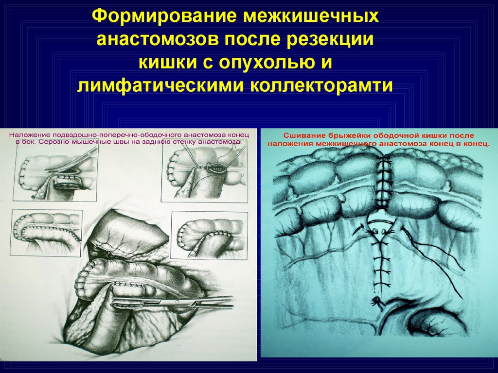 Кишечные анастомозы. Формирование межкишечных анастомозов. Межкишечный анастомоз бок в бок. Наложение межкишечного анастомоза.