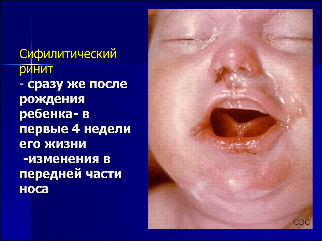 Сифилитический ринит - сразу же после рождения ребенка- в первые 4 недели его жизни -изменения в передней части носа