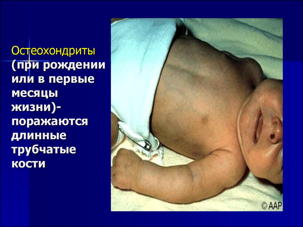 Остеохондриты (при рождении или в первые месяцы жизни)-поражаются длинные трубчатые кости