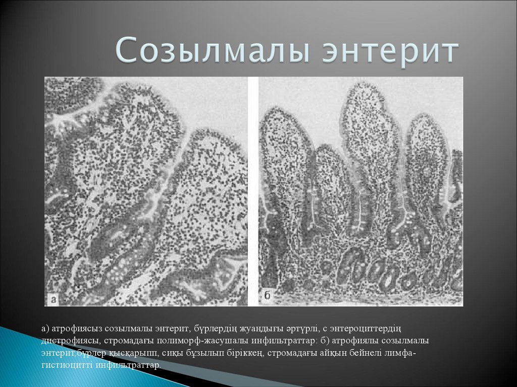 Картинки хронический энтерит