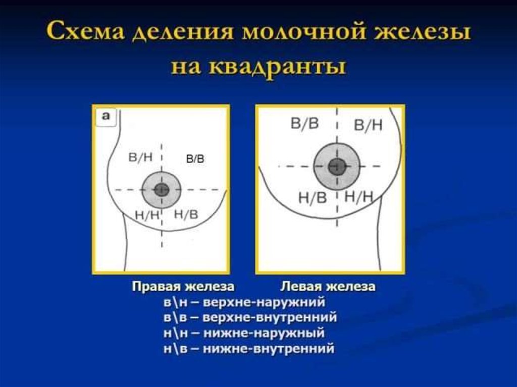 Левый верхний квадрат. Верхне-наружный Квадрант молочной железы. Верхних наружный кванлран молочной железы. Нижне внутренний Квадрант молочной железы. Квадранты молочной железы схема.