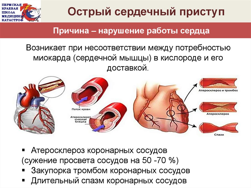 Первая помощь при острой сердечной недостаточности проект