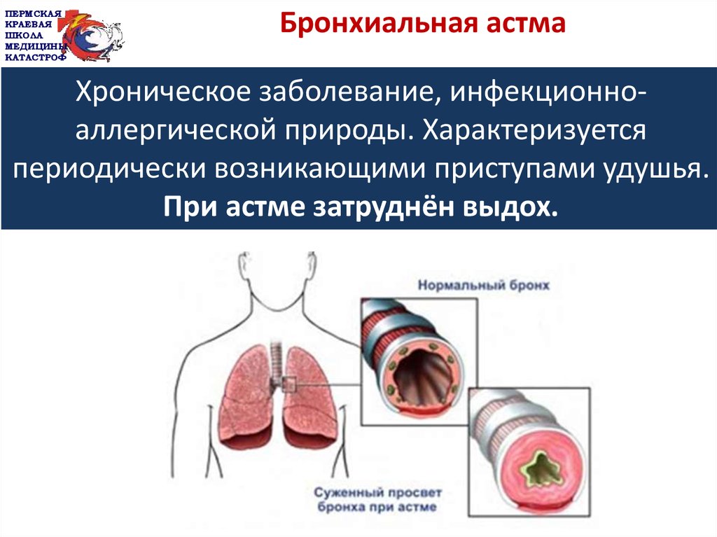 Сайт астм. Бронхиальная астма патология. Инфекционно зависимая форма бронхиальной астмы. Аллергические причины бронхиальной астмы. Бронхиальная астма инфекционно-аллергическая этиология.
