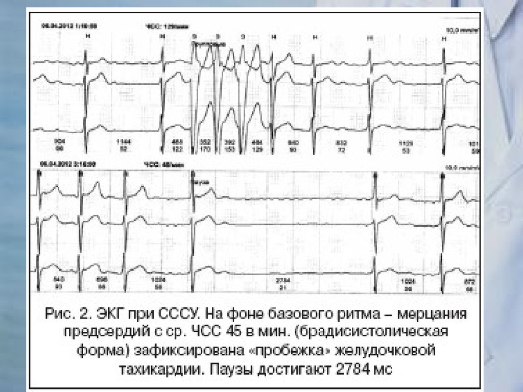 Синусовая брадикардия карта вызова скорой медицинской помощи