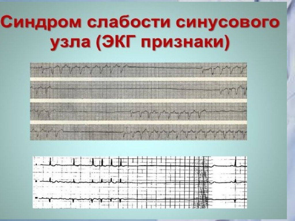 Синдром слабости синусового узла карта вызова смп