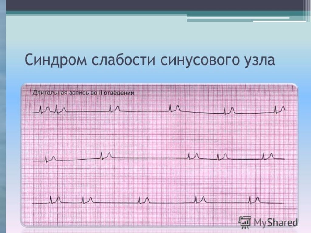 Лекция по теме Синдром слабости синусового узла и мерцательная аритмия 