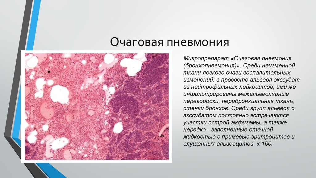 Очаговая пневмония это. Очагово сливная пневмония макропрепарат. Стафилококковая пневмония микропрепарат. Макропрепараты очаговых пневмоний. Экссудат при очаговой пневмонии.