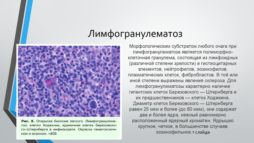 Морфологические изменения клеток. Опухолевые клетки при л. Лимфома Ходжкина гистология. Клетки Ходжкина и Березовского-Штернберга. Многоядерные клетки Березовского-Штернберга.