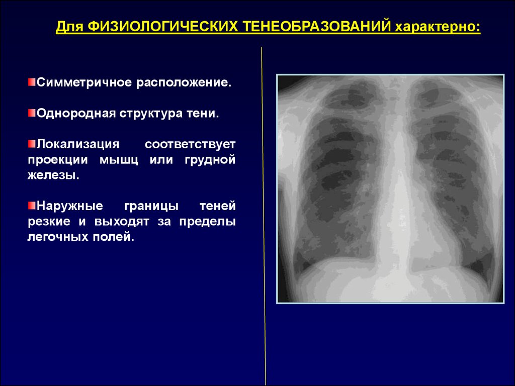 Синдромы поражения легких. Рентгенологические синдромы заболеваний легких. Рентген синдромы легких. 9 Рентгенологических синдромов легких. Легочные синдромы рентгенология.