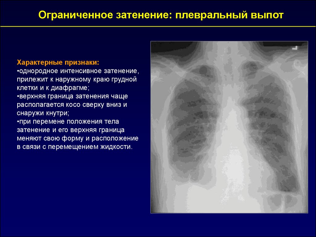 Пневмония синдромы