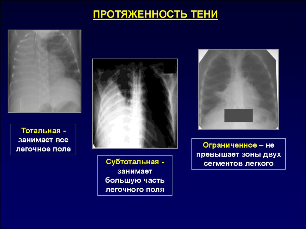 Синдромы легких