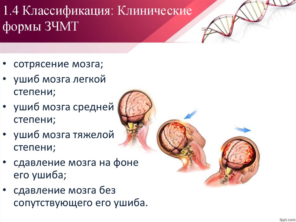 Зчмт сотрясение головного. ЗЧМТ ушиб головного мозга классификация. Закрытая черепно-мозговая травма. ЧМТ сотрясение головного мозга.