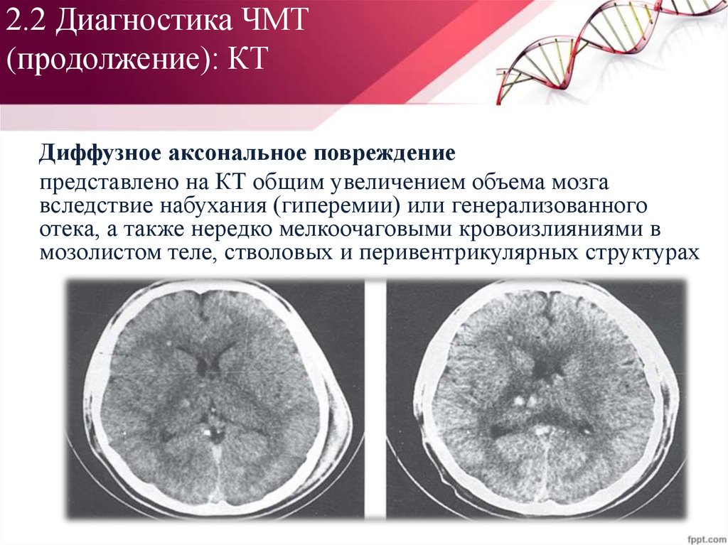 Диффузная травма головного