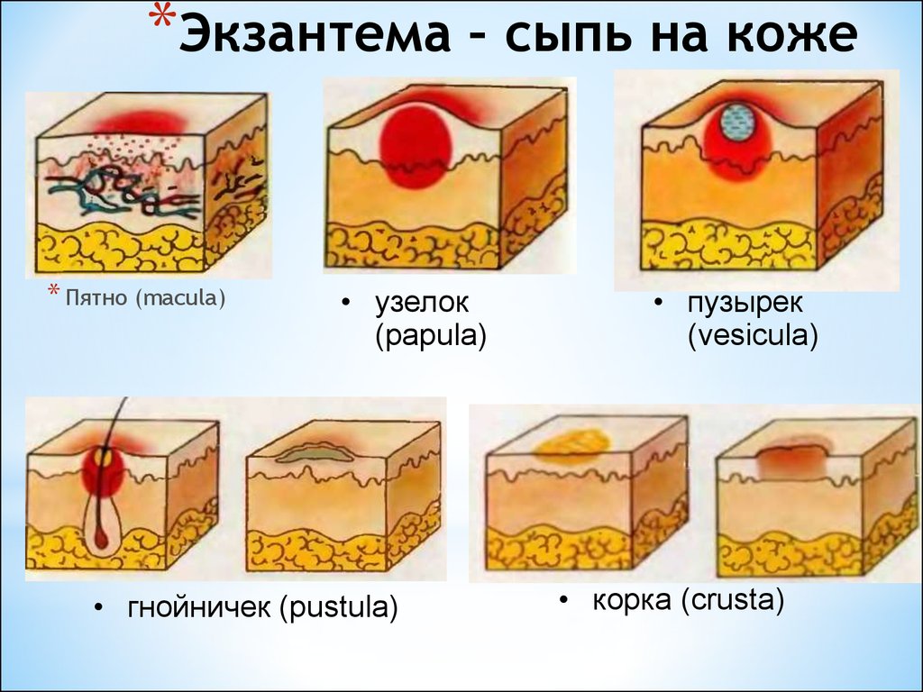 Виды Прыщей У Детей Фото