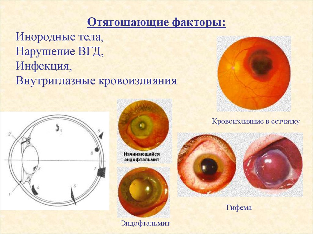 Заболевание и повреждение глаз биология 8 класс. Внутриглазное инородное тело. Инородное тело на сетчатке.