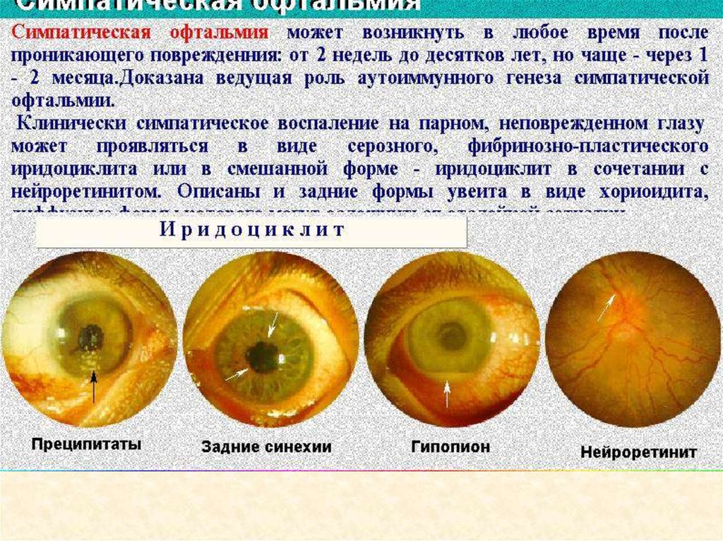Заболевания и повреждения глаз. Формы симпатического воспаления глаза. Стмпатический офиальмия. Симпатическое воспаление глаза.