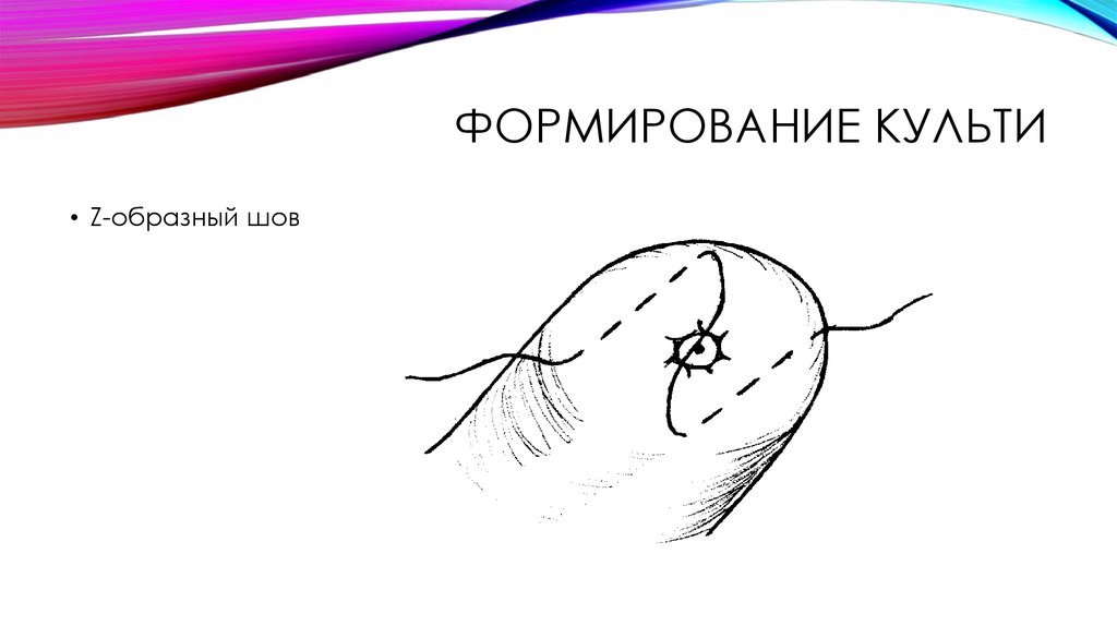 Формирование культи