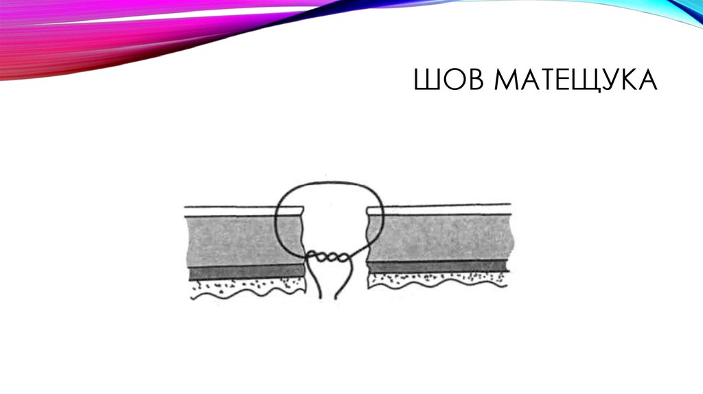 Шов матещука