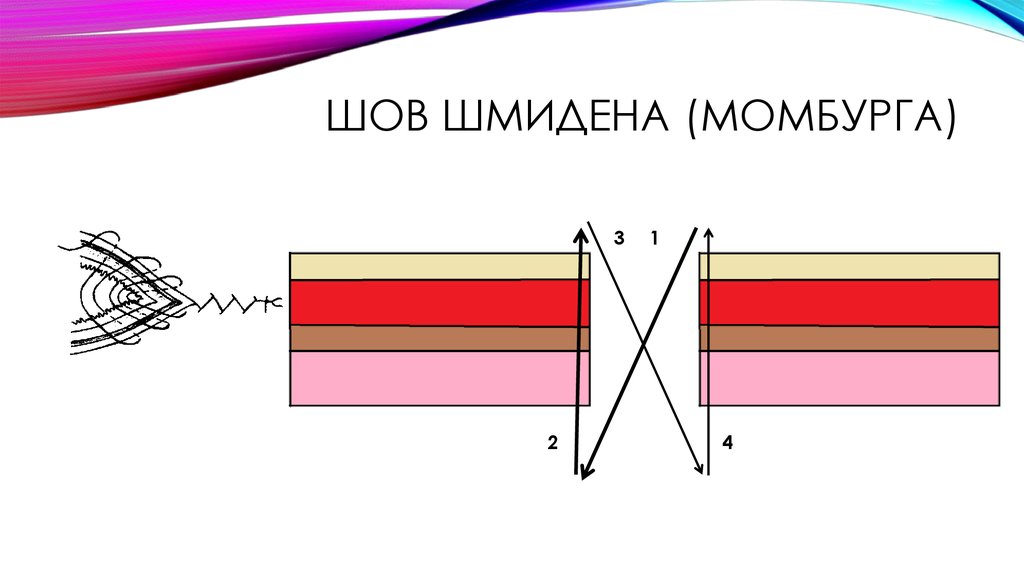 Шов шмидена (момбурга)