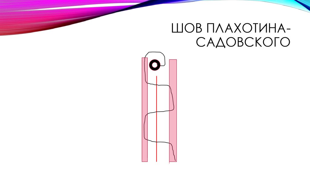 Шов плахотина-садовского