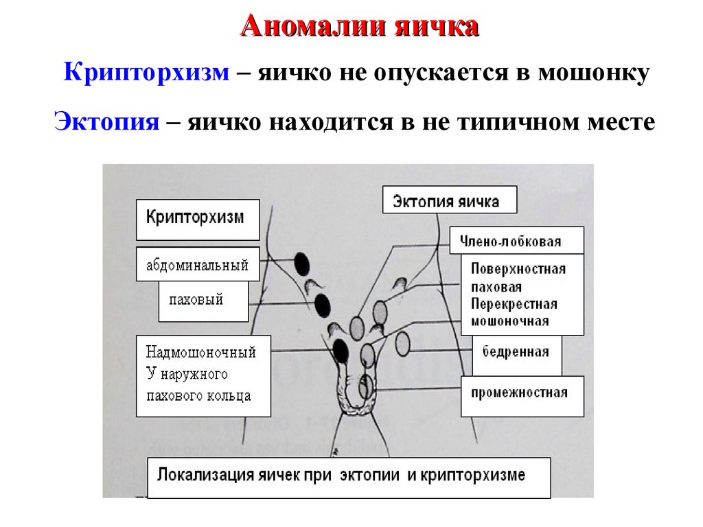 Правильные яички. Крипторхизм клинические рекомендации. Классификация крипторхизма у детей. Аномалии положения яичка. Осложнения крипторхизма.