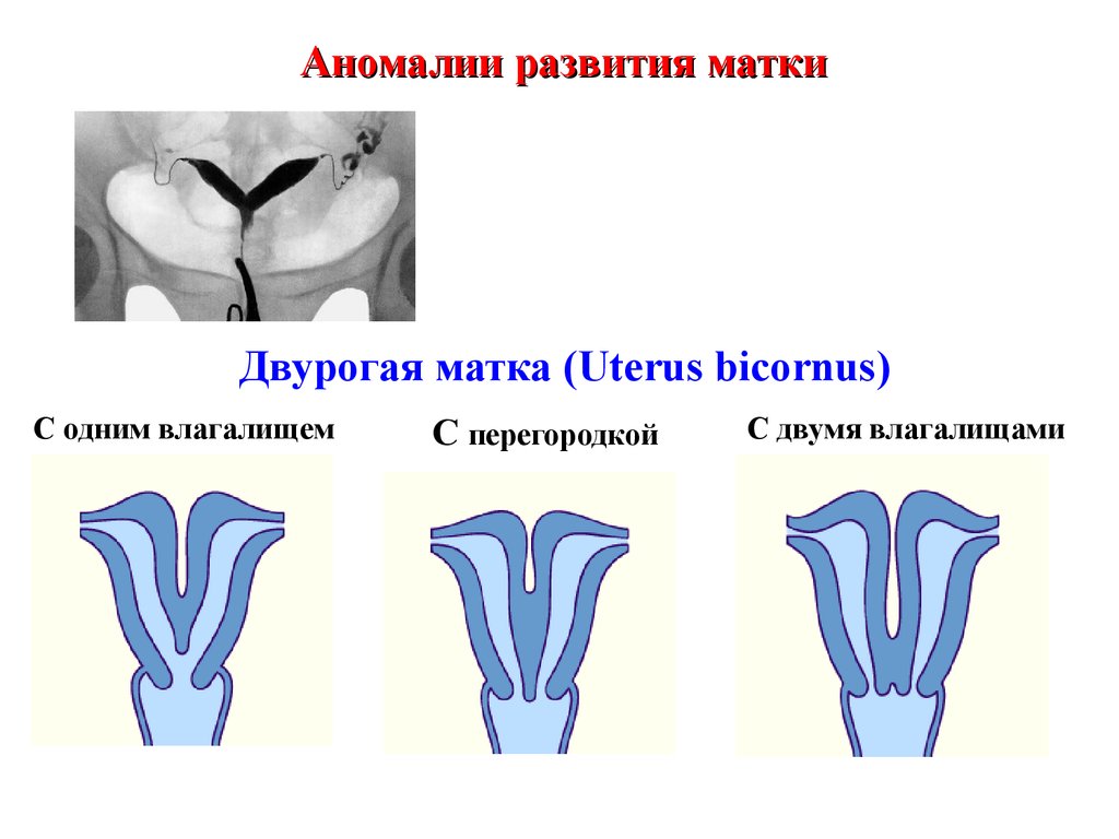 Седловидная матка. Двурогая седловидная матка. Аномалия матки двурогая. Пороки развития матки и беременность. Аномалия развития матки седловидная.