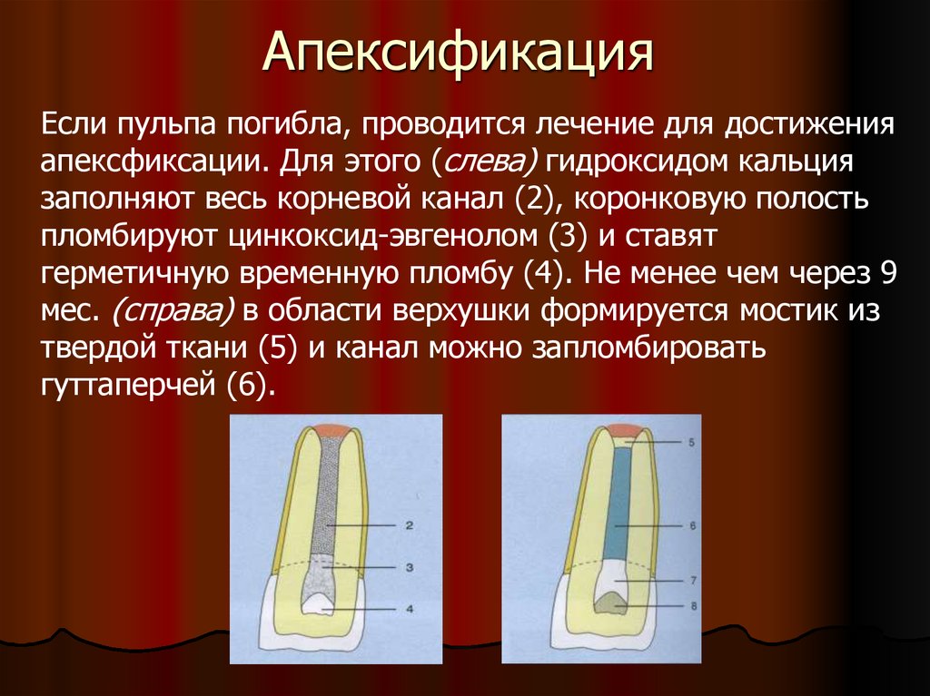 Периодонтит детская стоматология презентация