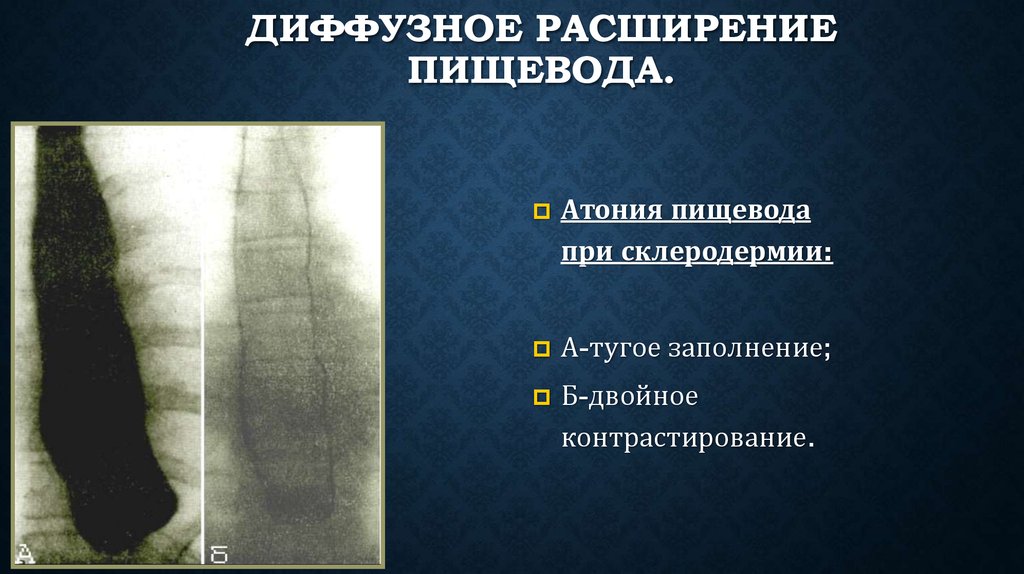 Лучевая диагностика пищевода презентация