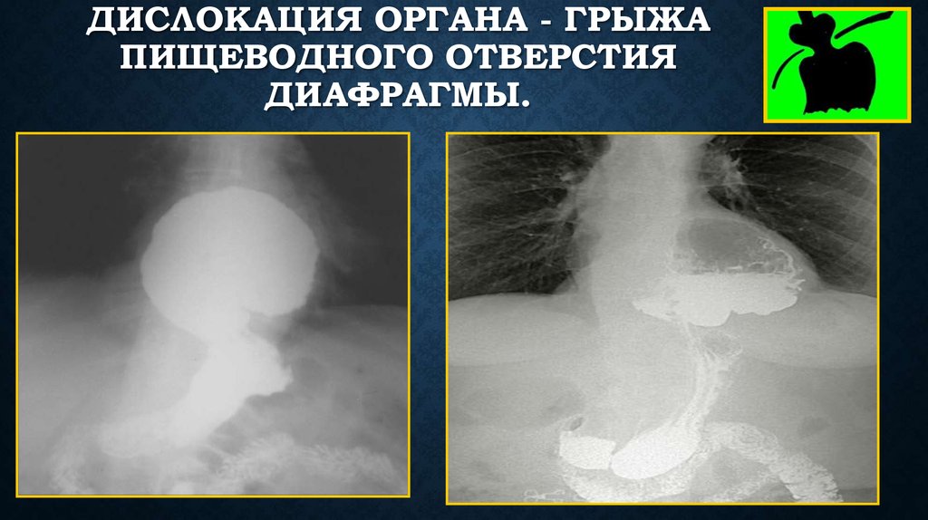 Грыжа пищеводного диафрагмы. Параэзофагеальная грыжа пищеводного отверстия диафрагмы рентген. Грыжа пищеводного отверстия диафрагмы рентген. Грыжа пищеводного отверстия рентген. Рентгенодиагностика грыжи пищеводного отверстия диафрагмы.