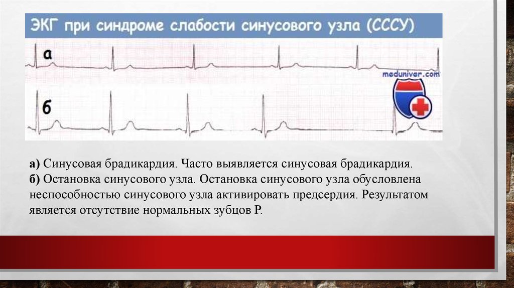 Синусовая брадикардия мкб. Синдром слабости синоатриального узла ЭКГ.