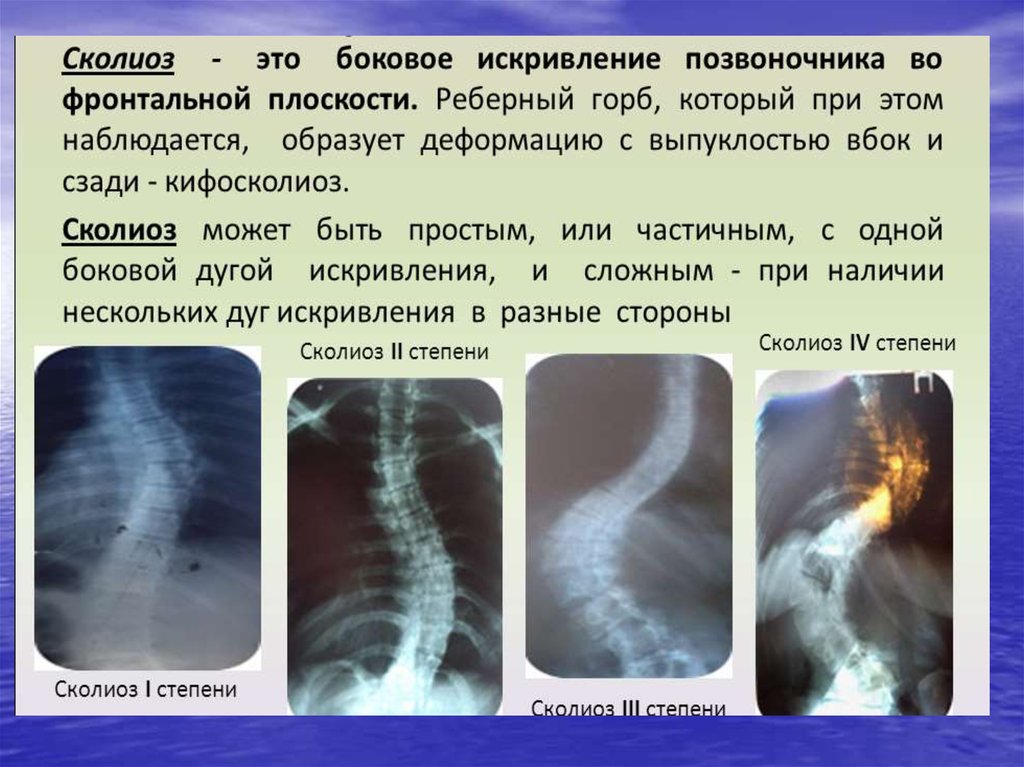 Презентация про сколиоз