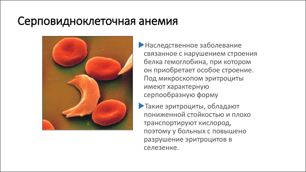 Эритроциты при серповидно клеточной анемии. Гемоглобин s при серповидноклеточной анемии. Строение гемоглобина при серповидноклеточной анемии. Серповидно клеточная анемия картина крови. Серповидная анемия эритроциты.