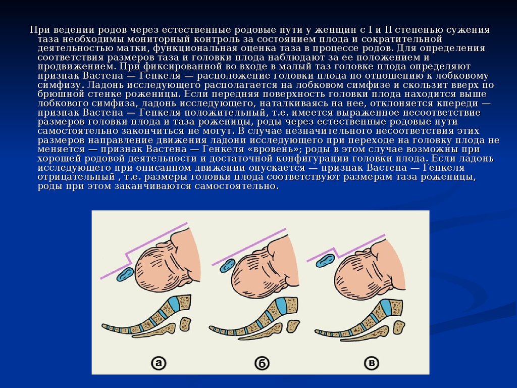 Анатомически узкий таз презентация