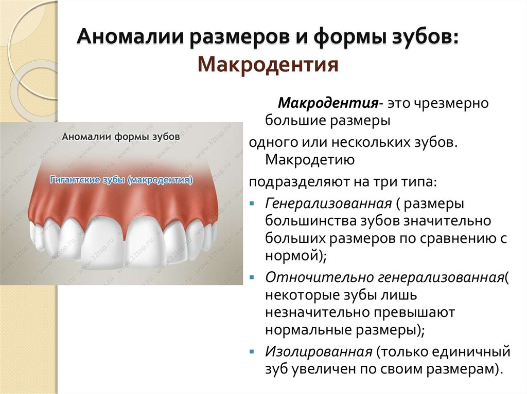 Аномалии список. Аномалии формы и величины зубов.