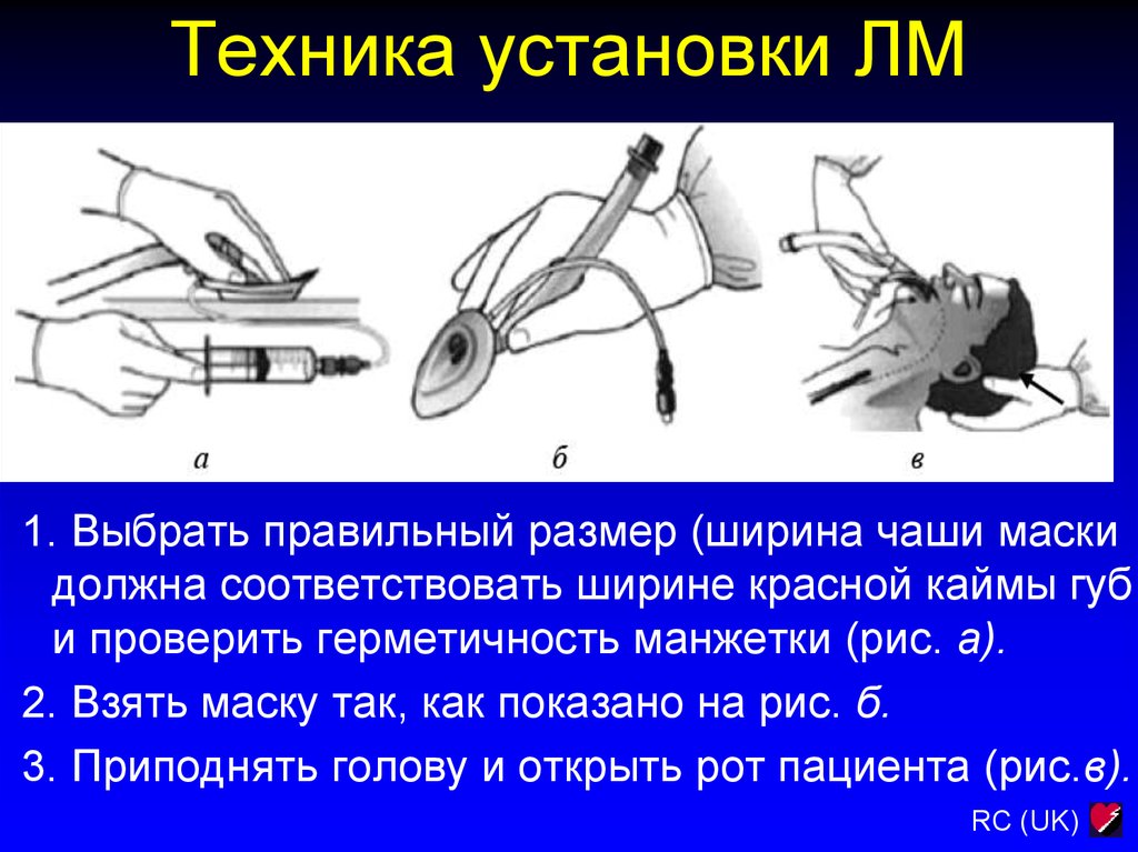 Техника установлена. Леска СЛР Размерность. Техника установки монту. Как проверить на герметичность шов бронха. Длина манжетки при операции.