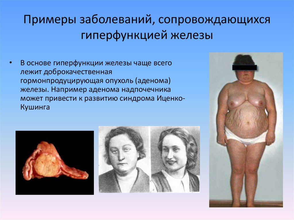 Примеры заболеваний, сопровождающихся гиперфункцией железы