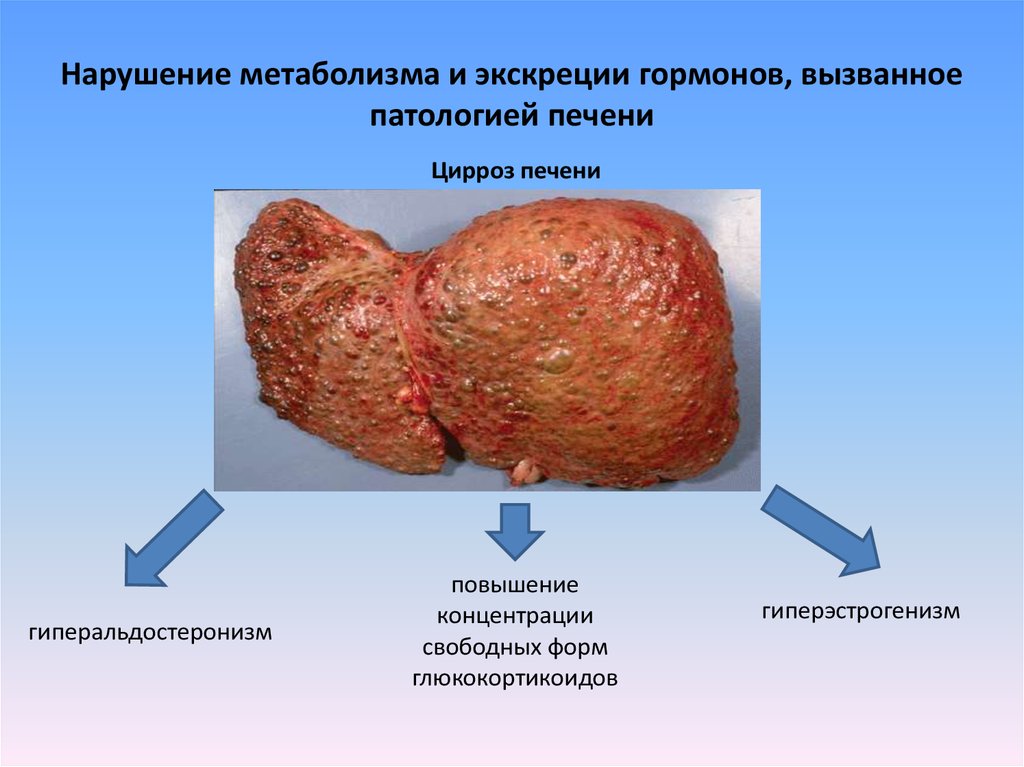 Нарушение метаболизма и экскреции гормонов, вызванное патологией печени