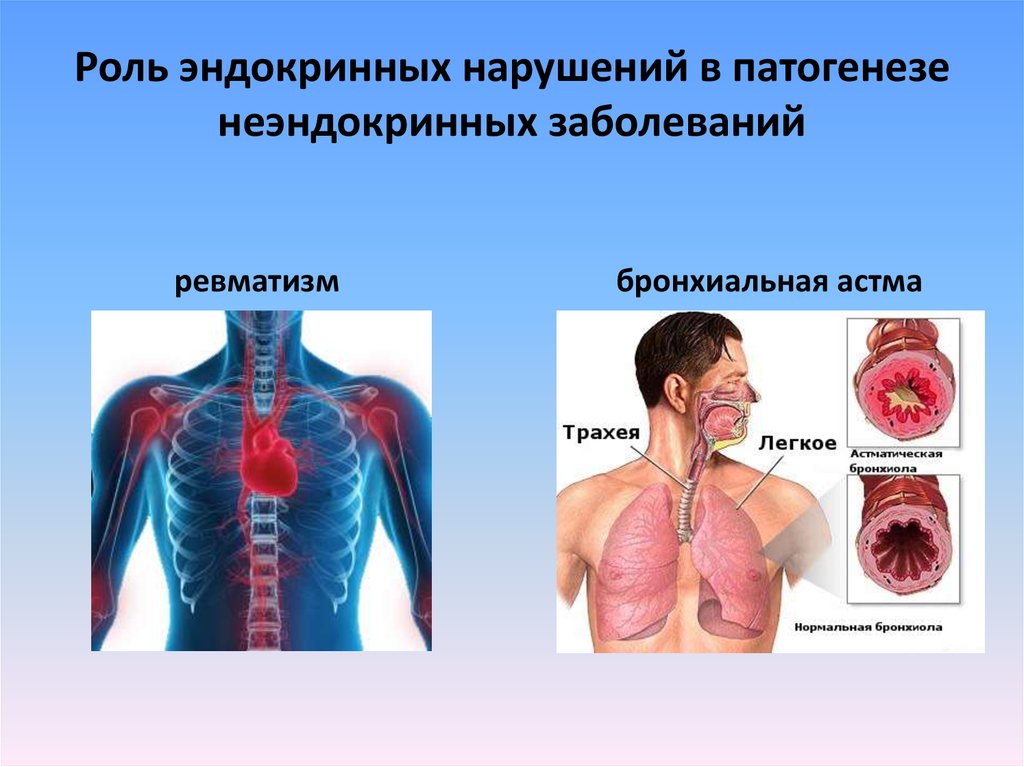 Эндокринные заболевания картинки для презентации