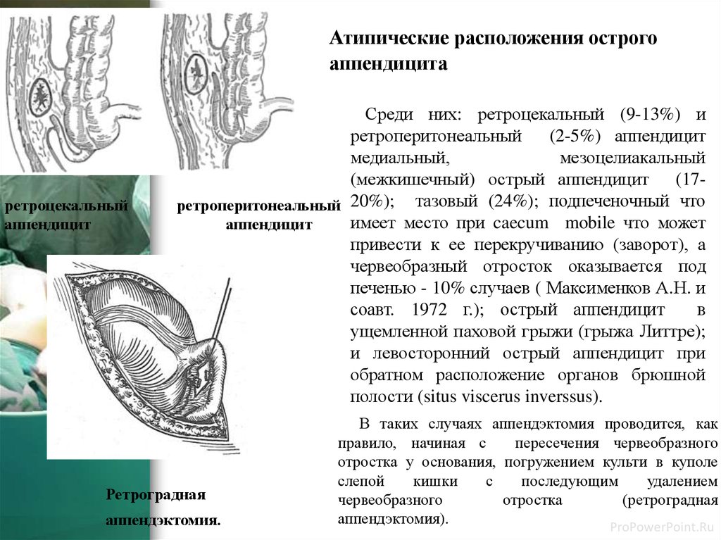 При типичной картине острого аппендицита операционным доступом является