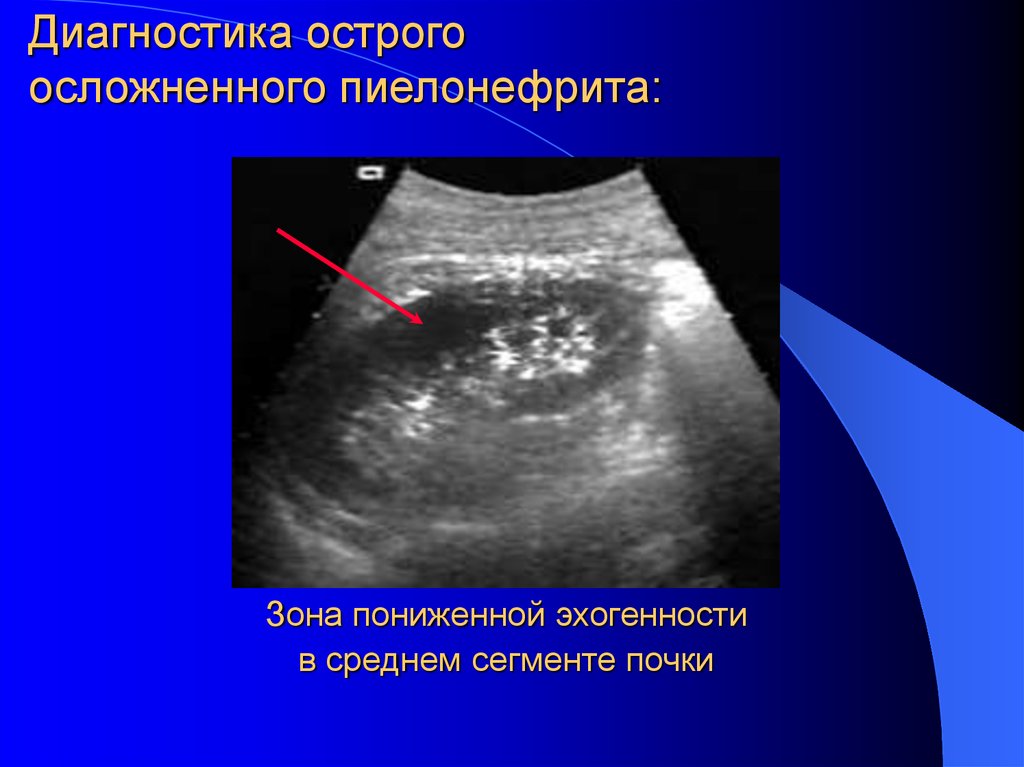 Диагностика почек. Зона пониженной эхогенности. Острый пиелонефрит диагностика. Острый пиелонефрит инструментальная диагностика. Острый пиелонефрит УЗИ.