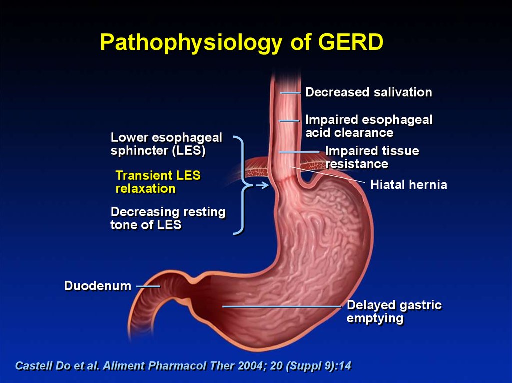 Сфинктер желудка. Gerd Pathophysiology.