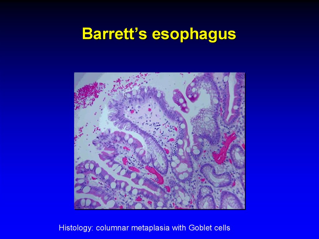 Barrett’s esophagus